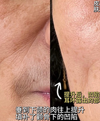 199元的无痛皮肤管理效果堪比医美,紧致,提升,淡纹,美白