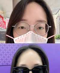 1000度高度近视,终于可以不用再戴眼镜了!说说我的治疗方式