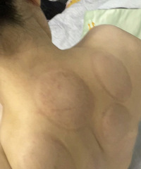 懂拔罐的来!为什么我拔罐一点颜色都没有?你们一般是啥颜色?