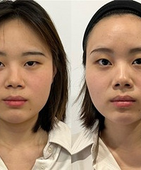 这次做的黄金超光子才几十块一次