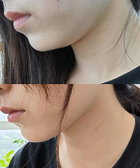 瘦但是也有双下巴,只有靠这个方法来解决!都说我的效果超级好