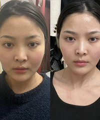 超声炮效果到底怎样?这是我做完1个月后的真实效果,脸小一圈