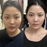 做完超声炮脸小一大圈