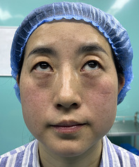 眼袋真的太显老!不开刀去眼袋全过程分享,30分钟甩掉大妈感