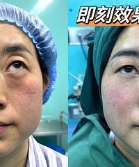 眼袋真的太显老!不开刀去眼袋全过程分享,30分钟甩掉大妈感