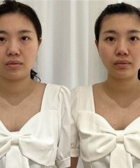 黄金炮现在好便宜,做一次脸小一圈