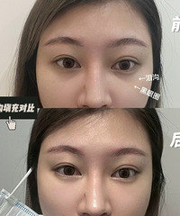 没有了泪沟和黑眼圈,不仅显年轻还更精神了!这眼周差别好大