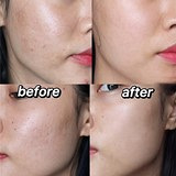 痘坑毛孔粗大就做这个