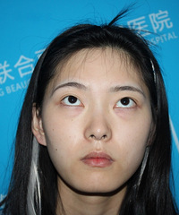 感觉自己24岁看着像30岁!去掉眼袋之后,不仅年轻了还更精神