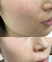终于明白好皮肤的重要性,坚持光子+水光,皮肤细腻肤色也提亮了
