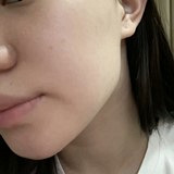 痘痘肌的皮肤恢复好了