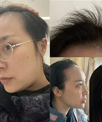 用这个方法,真的能长出头发
