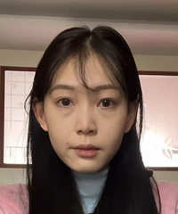袪眼袋7天,大家帮忙看看效果呢,不仅没什么伤口还不怎么痛