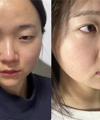 做了双眼皮后,变化大但很自然