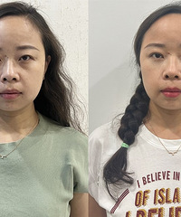 这个方法祛眼袋,不动刀还恢复快!没了眼袋,真的会变年轻很多岁