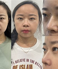 这个方法祛眼袋,不动刀还恢复快
