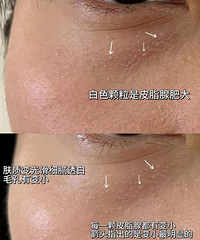 没想到一个199的皮肤管理,还能把眼睛下面的白色小颗粒都祛掉