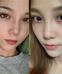 双眼皮手术过程大分享!各方面都给你讲