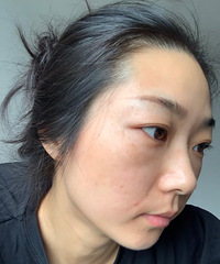 一次聊明白!黄褐斑怎么治?你早晚就能用得到