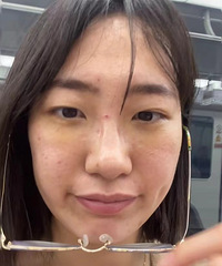 祛眼袋一周之后,卧蚕都出来了!看起来年轻不少
