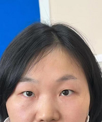 肿泡眼也能做双眼皮,恢复好之后,差别真的好大