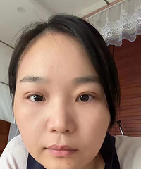 亲测!肿泡眼也能做双眼皮,恢复好之后,差别真的好大