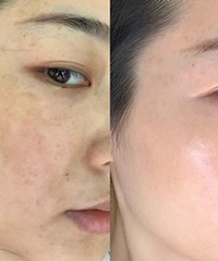 一次给你聊明白,黄褐斑怎么治
