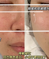 199元皮肤管理,能修护“玫瑰痤疮”,也能抗老美白,紧致提升