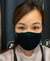 肿泡眼做了双眼皮后,感觉变化好大!1个月就很自然了
