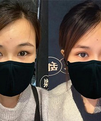 肿泡眼做双眼皮后,1个月就很自然了