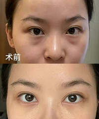 做了激光祛眼袋,真的看不出手术痕迹!现在眼睛没有一点疲惫感了