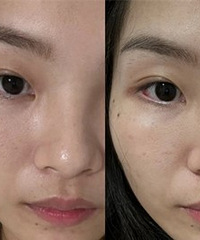 �ƽ𳬹���3�Σ�Ƥ���仯�ô�