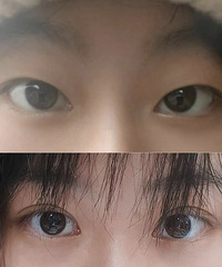 3年前就在论坛做双眼皮功课的我,来给大家反馈了!都说很自然