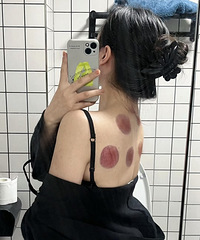 拔罐真能祛湿吗?体验后确实一身轻松,你觉得还有什么好处