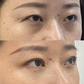 没了眼袋,变年轻很多