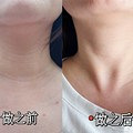 10年的颈纹都快没了