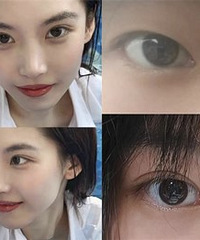 3年前就做双眼皮功课的我,来反馈了