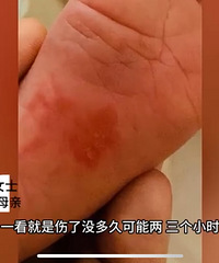 上海一出生12天女婴被月嫂挠伤脚底