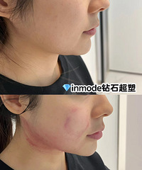 这个瘦脸神器对双下巴和嘴角嘟嘟肉,效果太好!下颌缘立马出现