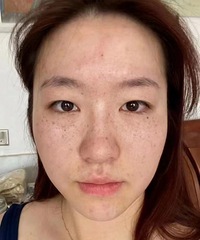 我的斑太严重了!坚持做了3次,好像换了层皮,现在皮肤好干净