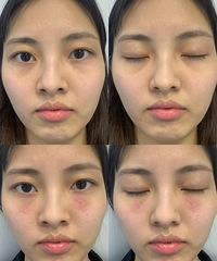 黑眼圈和泪沟不仅显老还显憔悴!做了这个项目,真的一劳永逸
