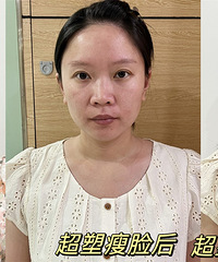 强烈安利肉肉脸去做这个双重瘦脸组合,双下巴变出清晰下颌线