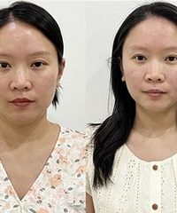 这个双重瘦脸组合,做一次就好明显