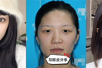 全切双眼皮恢复记录,眼睛大得像变了一个人