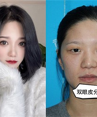 做了双眼皮之后,眼睛变大一倍