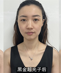 我花58元就做了一次黑金超光子+水光,像换一层皮肤,又白又嫩
