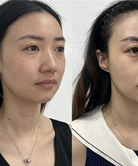 58元做了黑金超光子+水光,变化好大