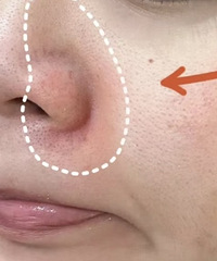 鼻翼一圈泛红,到底是怎么回事?很多人都推荐这个方法