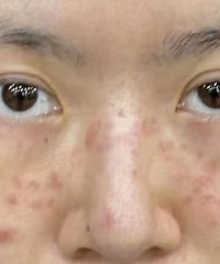 真实无P图!看看做完皮秒祛斑一周后的变化,7天就掉干净了