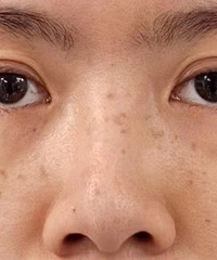 [Ч��]����ҿ���Ƥ�����һ�ܺ�ÿ����沿�仯����ʵ��P